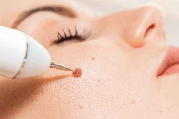 CryoPen: 5 Skin Concerns It May Be Used to Treat 3 What actually happens during a CryoPen treatment Goadby?