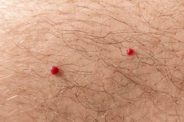 CryoPen: 5 Skin Concerns It May Be Used to Treat 2 cherry angioma removal Goadby