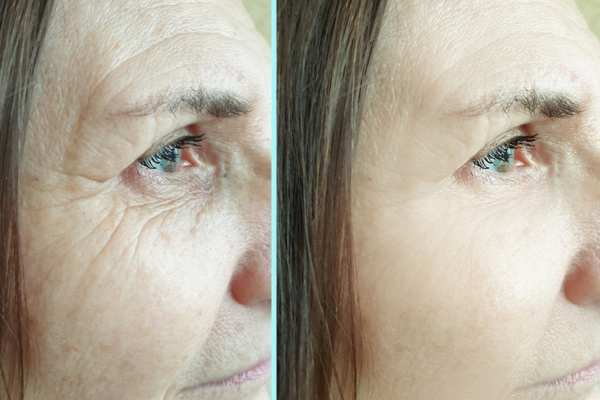 Why Do People Choose HIFU for a Non-Surgical Facelift? 4 How long can HIFU results last Goadby?