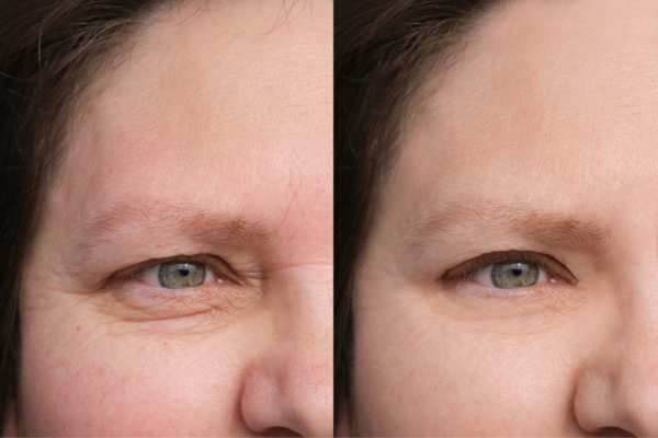 HIFU vs Botulinum Toxin: Understanding the Differences 4 How long do HIFU results last Goadby?