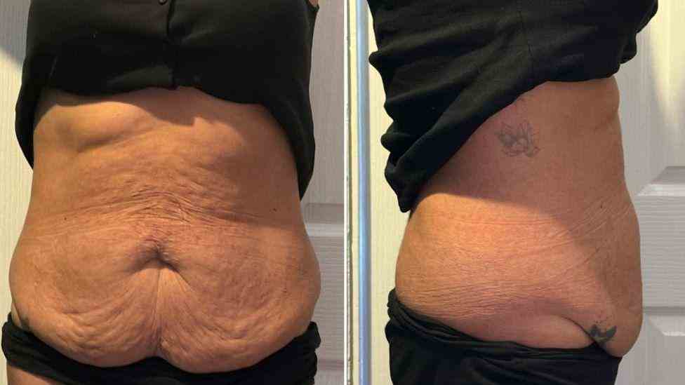 Lost the Weight but Not the Loose Skin? What You Should Know 1 Is It Definitely Loose Skin Goadby?